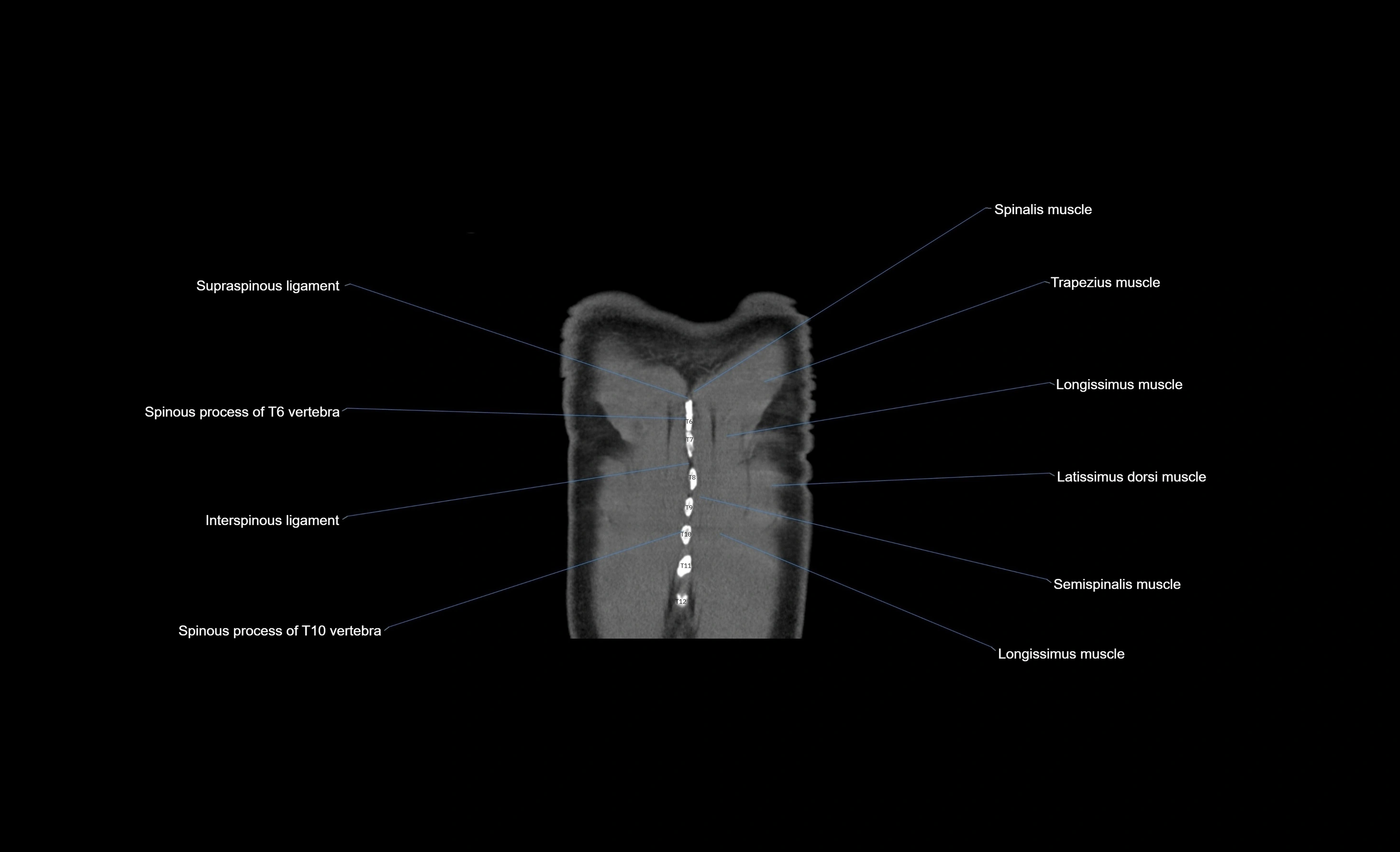 CT chest (thorax) soft tissue window labelled coronal cross sectional anatomy radiology image-00007.webp